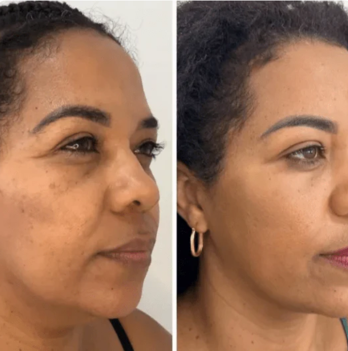 Collagen Fit - Efeito lifting imediato sem agulhas nem dor.